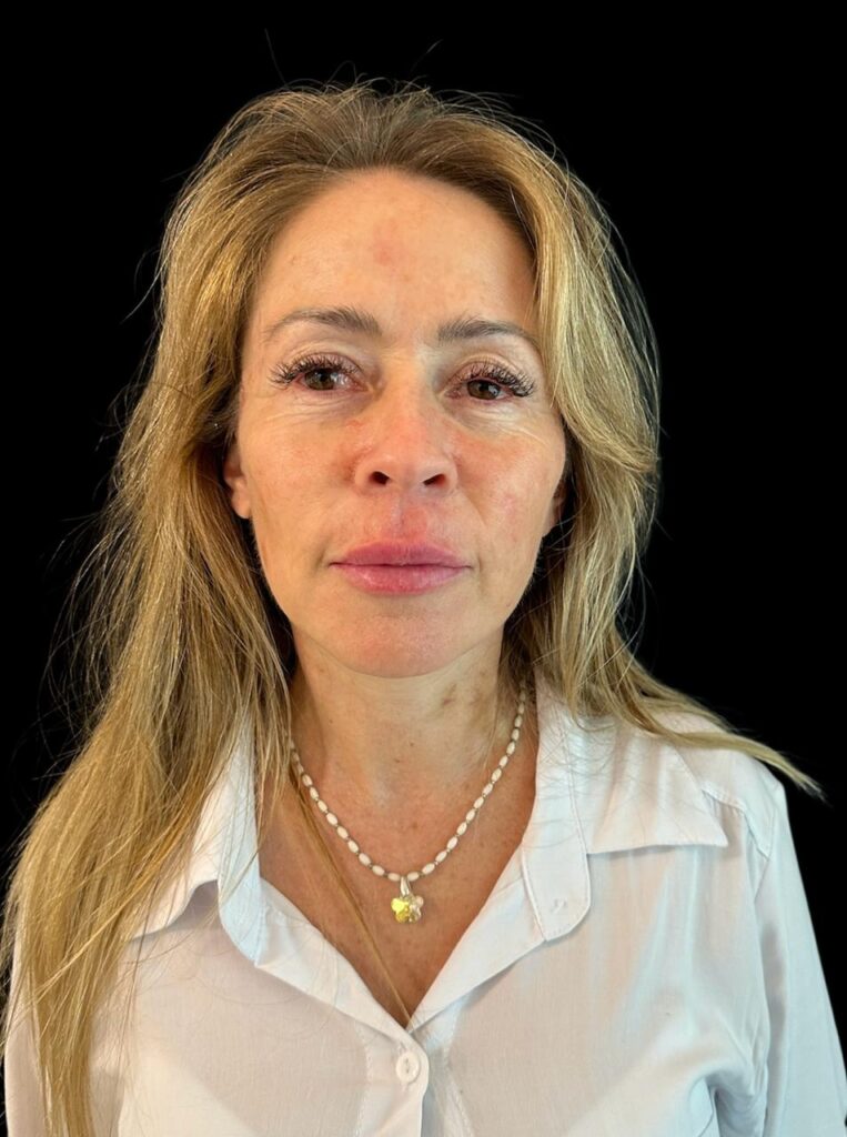 Resultado de lifting facial – antes y después 14