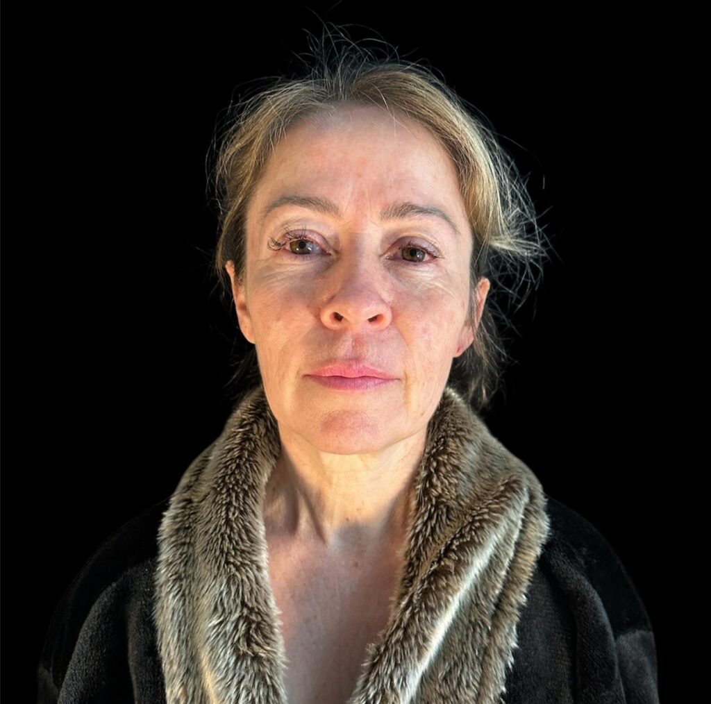 Resultado de lifting facial – antes y después 13