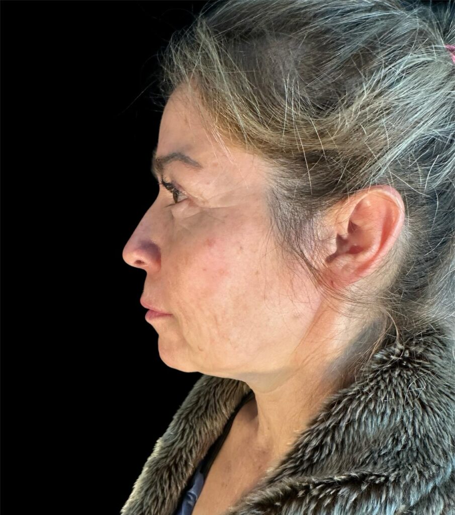 Resultado de lifting facial – antes y después 15