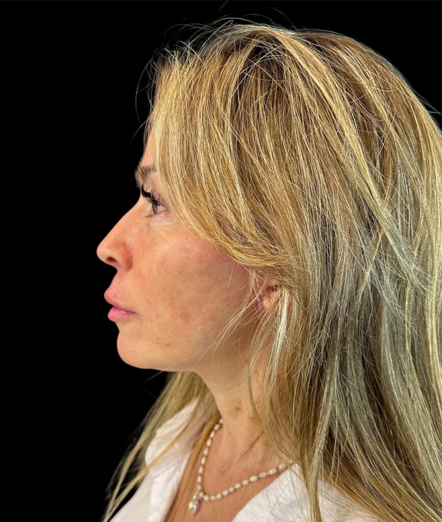 Resultado de lifting facial – antes y después 16